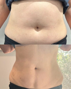 "The staff at Revel22 are absolutely amazing - always professional, supportive, and genuinely invested in your success. With their tools and guidance, I've seen great results and feel better than I have in a long time. I've had a wonderful experience, and I highly recommend to anyone looking for a program that truly work and a team that cares!" nuSHAPE fat burning patient results - a before and after of a nuFORM patient's abdomen.