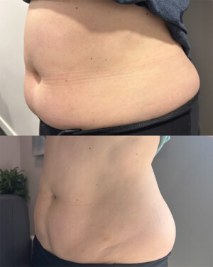 "The staff at Revel22 are absolutely amazing - always professional, supportive, and genuinely invested in your success. With their tools and guidance, I've seen great results and feel better than I have in a long time. I've had a wonderful experience, and I highly recommend to anyone looking for a program that truly work and a team that cares!" nuSHAPE fat burning patient results - a before and after of a nuFORM patient's abdomen.