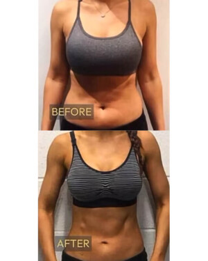 nuFORM muscle toning and building patient results - a before and after of a nuFORM patient's abdomen. A before and after shot of a female's core after utilizing nuFORM