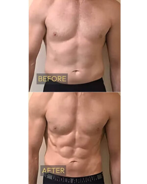 nuFORM muscle toning and building patient results - a before and after of a nuFORM patient's abdomen. A before and after shot of a male's core after utilizing nuFORM