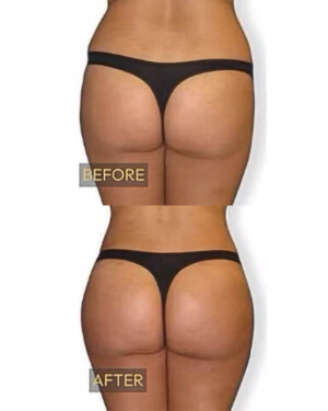 nuFORM muscle toning and building patient results - a before and after of a nuFORM patient's glutes. A before and after shot of a female's glutes after utilizing nuFORM
